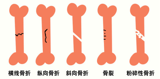 猫骨折了不治疗会怎么样？