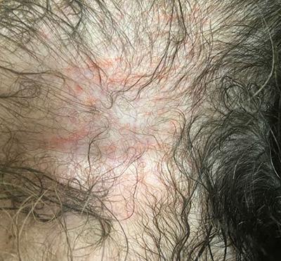 狗狗大腿内侧有红疹子，究竟是什么东西？